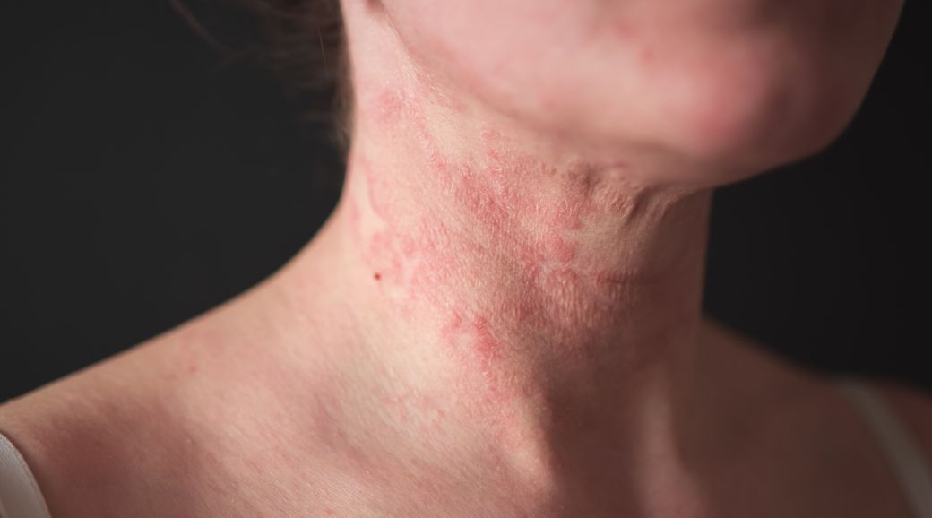 Eczema prone skin | Independent trial results revealed
